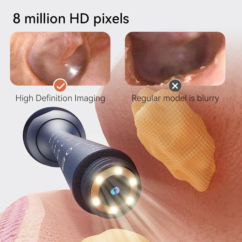 Smart Visual Ear Wax Removal System with 800W HD Endoscope and Storage Solution
